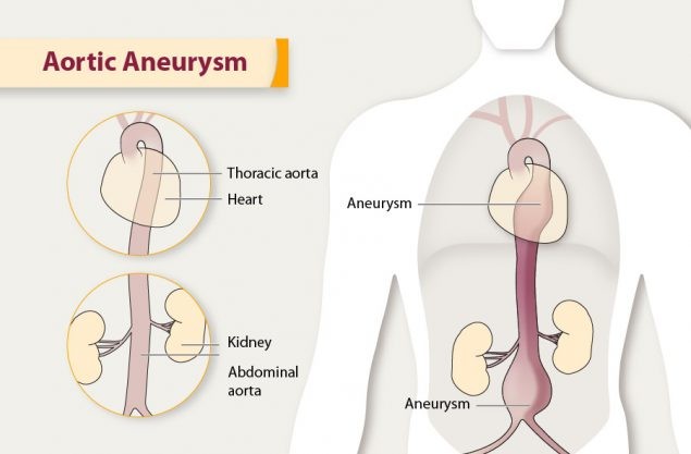 aortic aneurysms