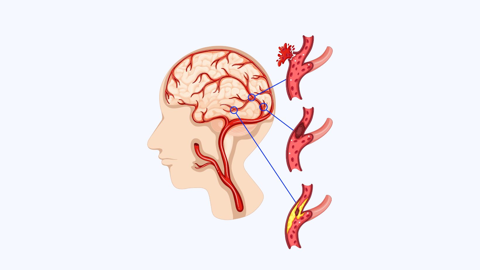 How to Recognize Aneurysm Headache?