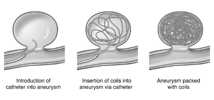 Minimally Invasive Endovascular Coiling