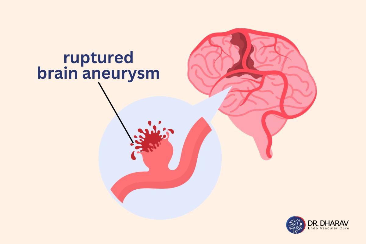 Ruptured Brain Aneurysm